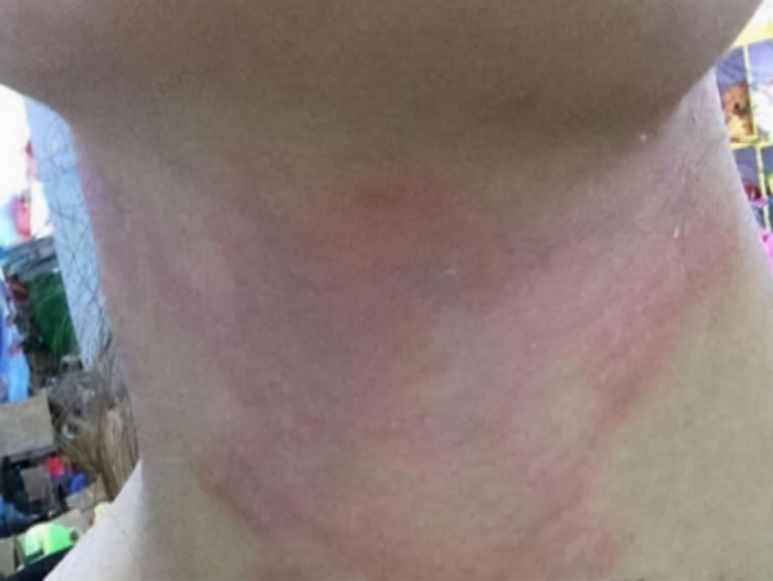 被隐翅虫毒液沾到涂什么药膏,被隐翅虫咬伤特效药