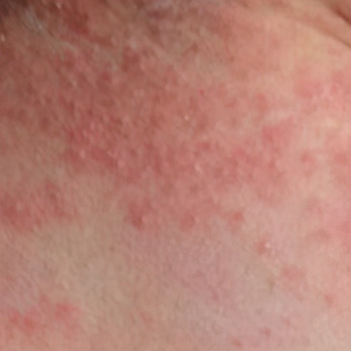 孩子老爱长痱子怎么办,儿童长痱子用什么药好