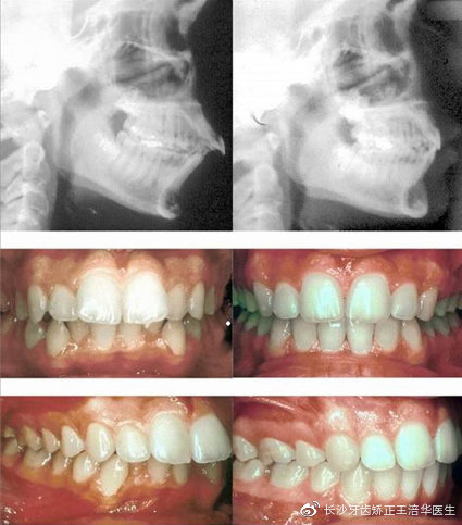 下巴短小怎么办不整容可以改变吗,下巴短后缩下颌线不明显怎么改善
