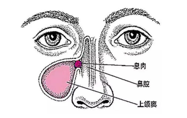 耳鼻喉专家讲解鼻窦炎,鼻窦炎最严重的症状及表现