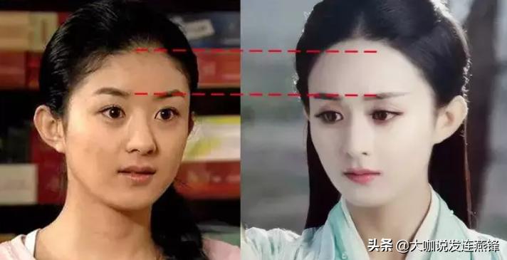 2500单位发际线,2000单位植发