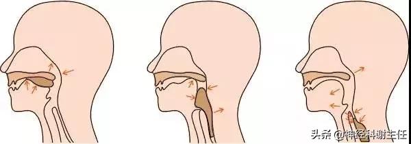 中风后吞咽困难中医的治疗方法,中风后怎么恢复吞咽训练