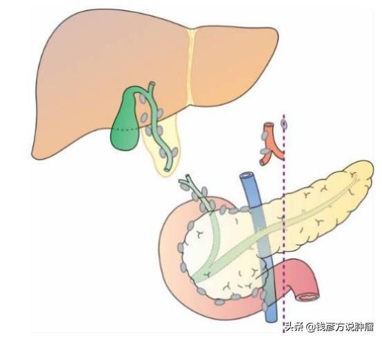 中晚期肿瘤最佳治疗方法是什么,膀胱癌肿瘤晚期吃中药有用吗