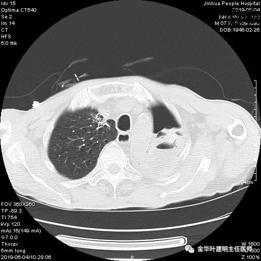 手术引起乳糜胸,有没有做了肺结节手术后是误诊的
