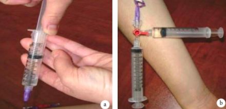 深静脉回血堵管怎么办,深静脉置管抽不出回血怎么办