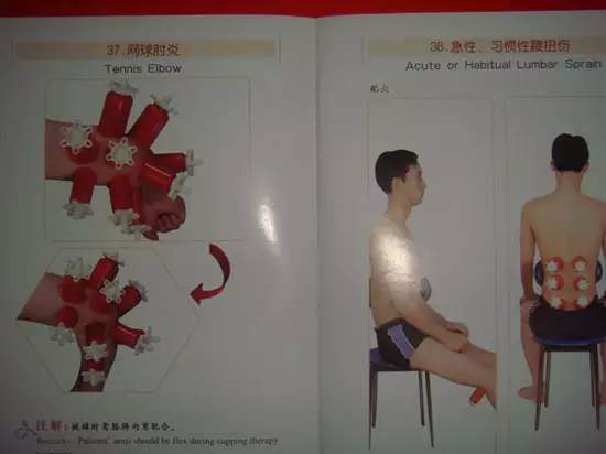 拔罐有哪些穴位图解,最全拔罐穴位疗法图解