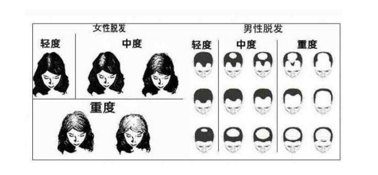 脱发最佳治疗方法白醋,油脂性脱发怎么改善生发