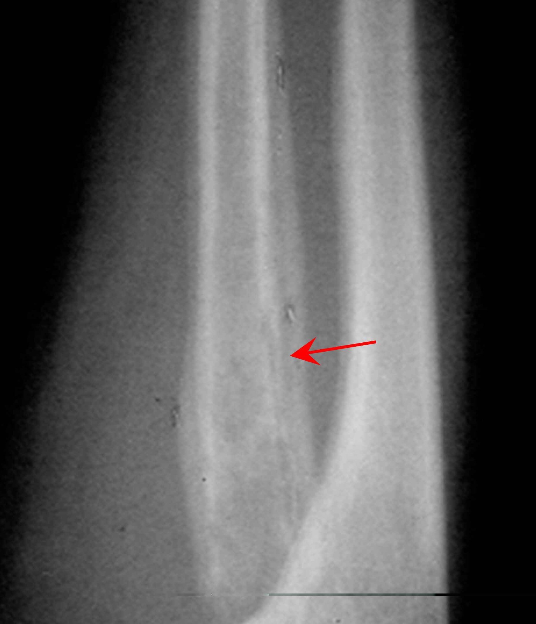 不典型的骨髓炎能根治吗,彻底治疗骨髓炎