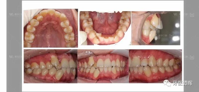 牙齿拥挤9个月变化图,牙齿拥挤排齐后嘴会凸吗
