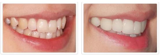 什么方法最适合去黄牙不伤牙齿,一口老黄牙怎么治疗