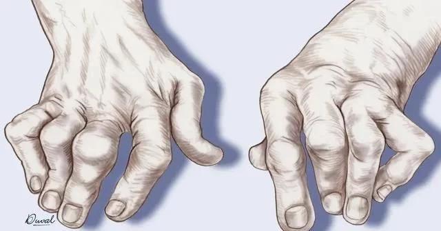 尿酸到底是什么引起的,尿酸是自身原因吗