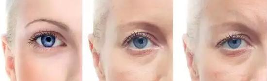 切眼袋会加速衰老的案例,割双眼皮衰老更快