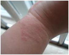 宝宝手指脱皮严重用什么药膏,手指脱皮抹什么药膏