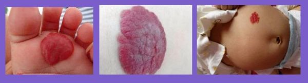 小孩身上出现红色印记,儿童身上有红色印记