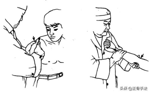 骨错则筋挪,关节脱位引起筋肉损伤时,4种整骨手法帮您复位