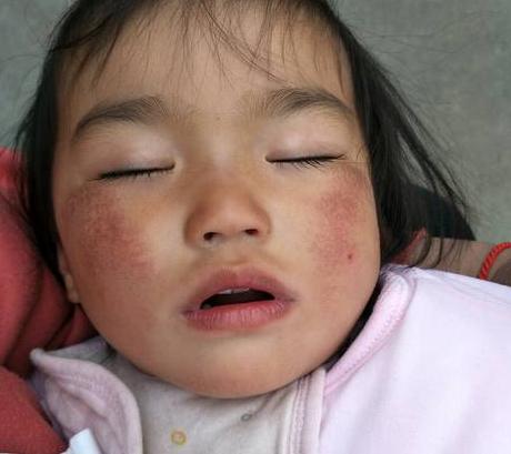 冬季寒冷干燥，不想娃的脸变成“红苹果”，这些护理父母要知道