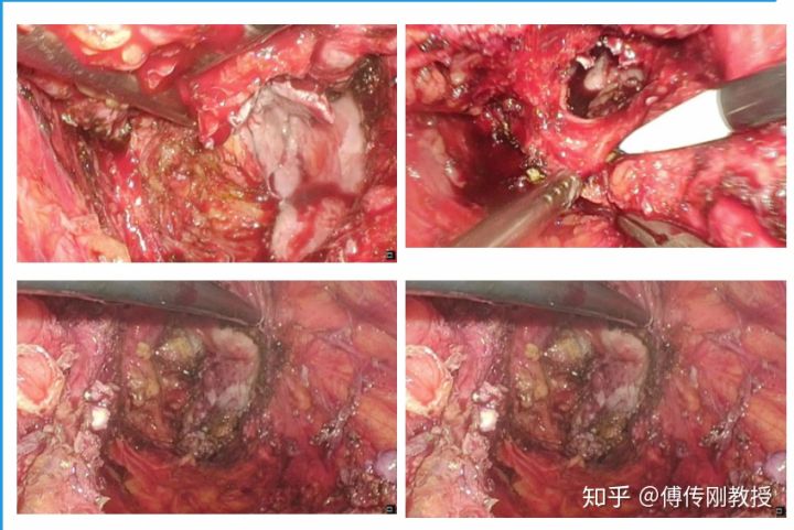 经历各种手术才活下来,经历了很多次手术
