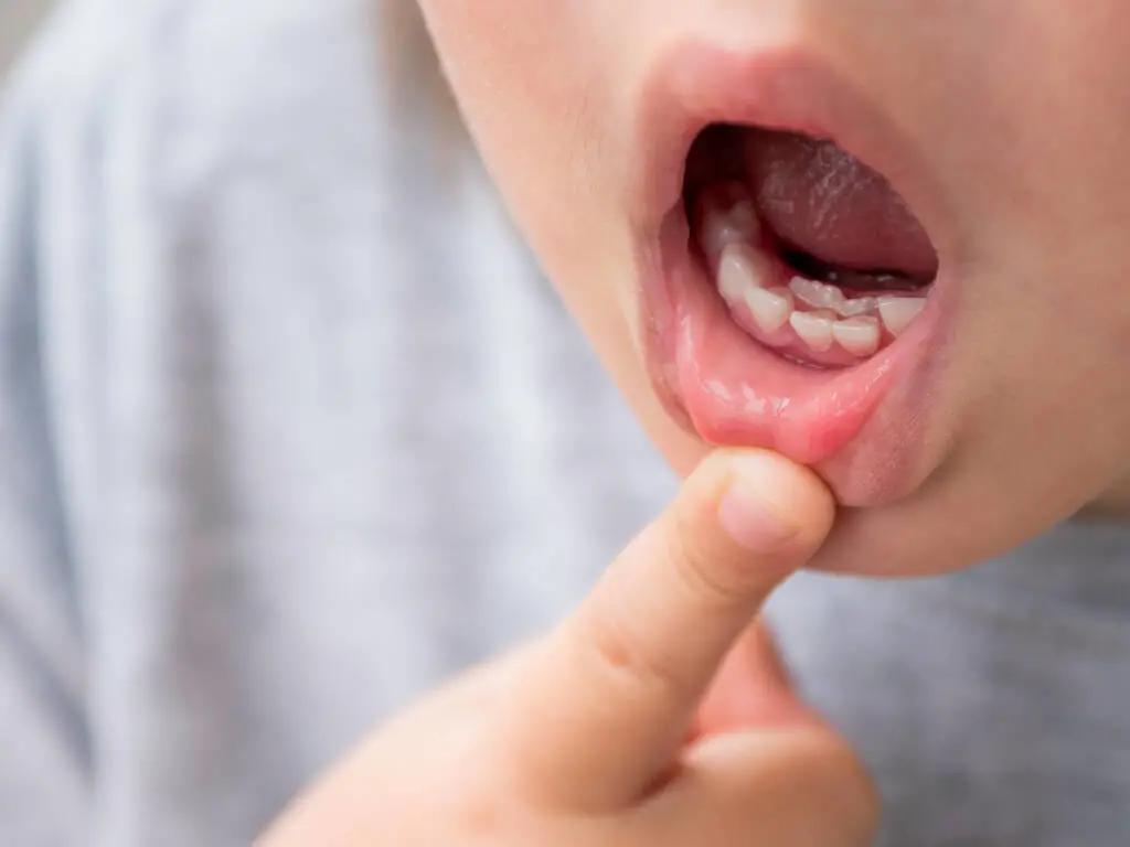 真诚发问：如何治疗口腔溃疡？