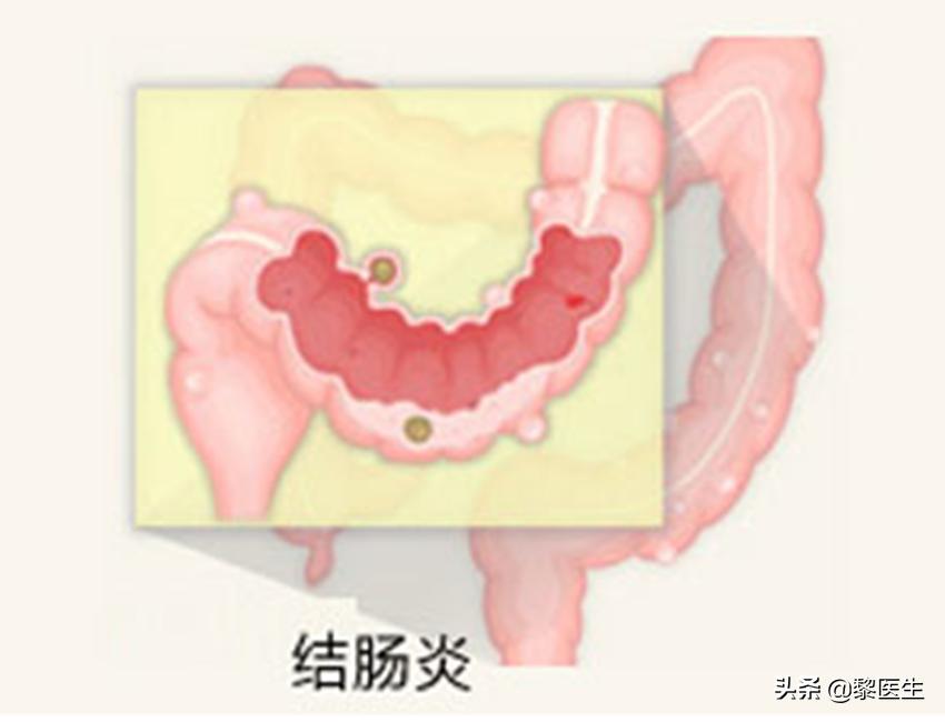安倍晋三溃疡性结肠炎复发辞职,安倍晋三患溃疡性结肠炎多少年