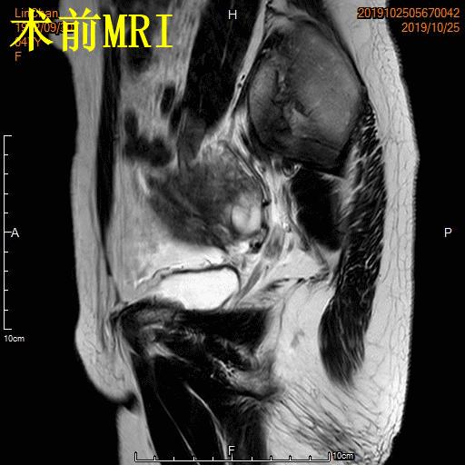 子宫腺肌症「不死的癌症」——介入栓塞来帮忙