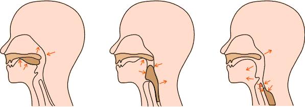 吃饭噎是食道癌的前兆吗,吃饭食道噎得慌