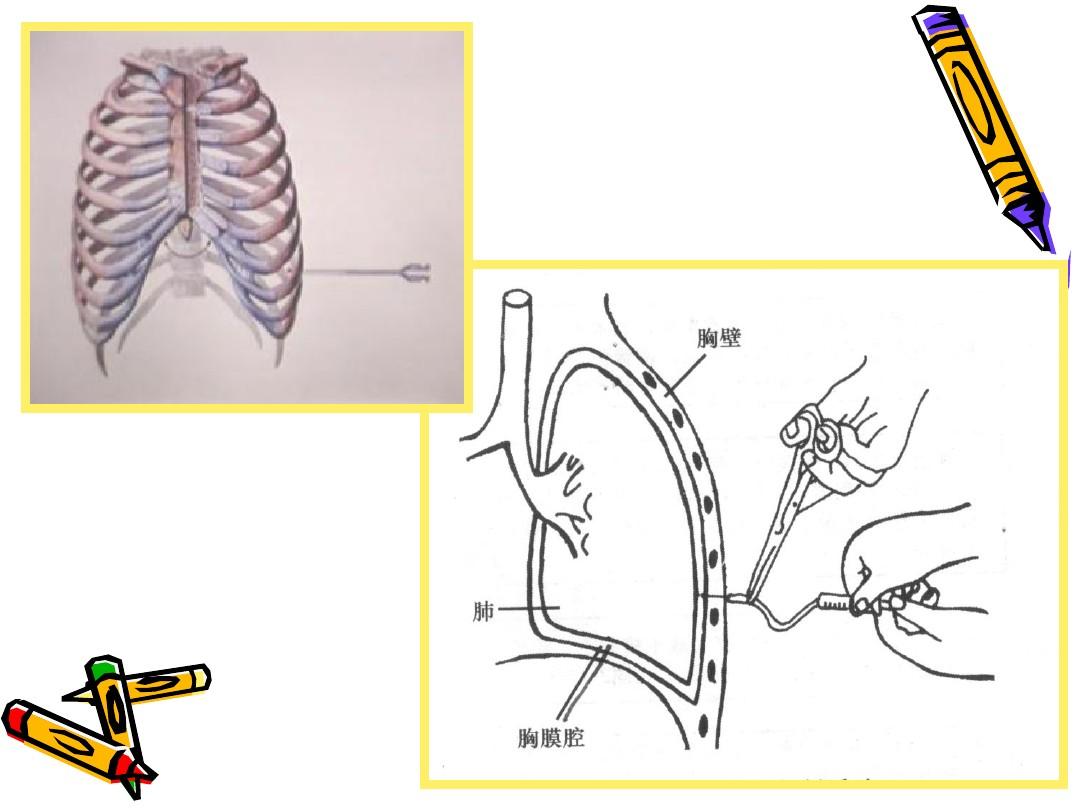 胸腔积液恶性怎么办,胸腔恶性积液