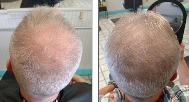 26岁女子治疗脱发,尿液治脱发