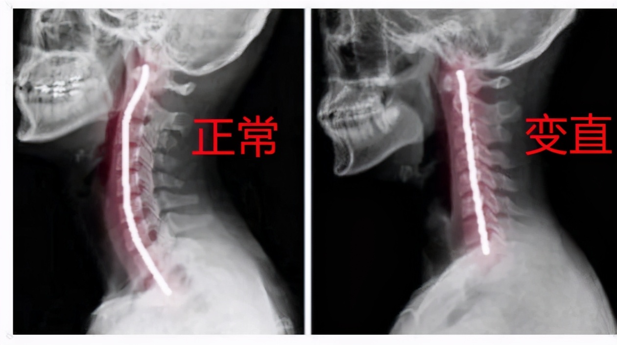 颈椎变直专用枕头,颈椎变直怎么办