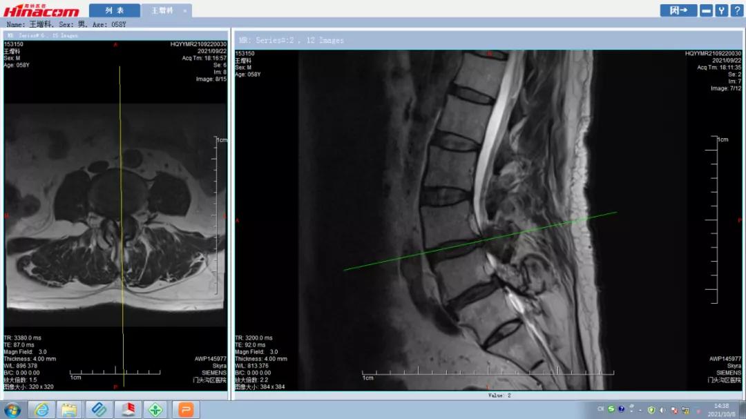 再也不用歪着身子走路了—区医院脊柱中心（骨二科）成功实施腰椎间盘摘除、椎间植骨融合钉棒内固定术