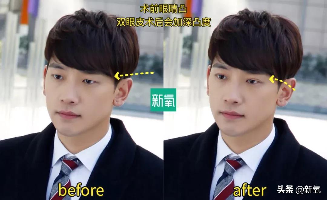 做双眼皮的姐妹还是要慎重,姐妹们你们割双眼皮多少钱