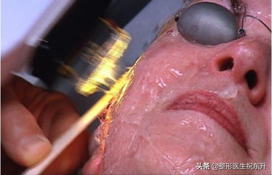 医生不会说的祛斑,医生不建议做光子美容