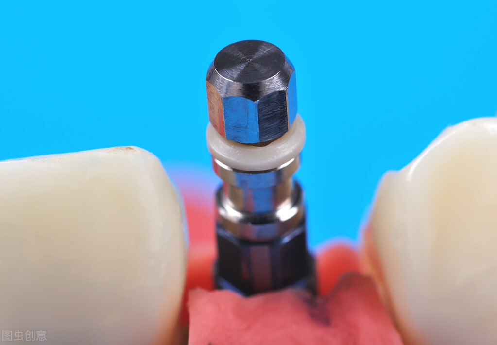 种植牙普通的和进口的有什么区别,种植牙各个国家的区别