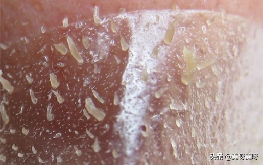 人为什么会长黑头求解：黑头白头的成因及结构和去除方法