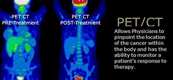 复查ct肺结节消失了,做了ct发现有肺结节复查没有了