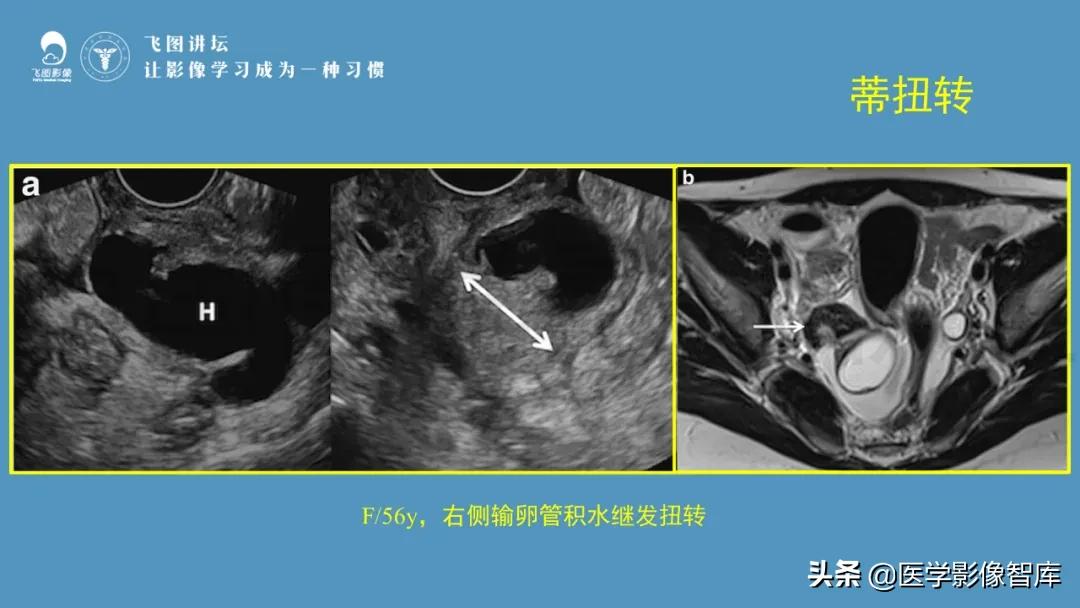 子宫解剖结构输卵管和卵巢位置,子宫附件ct影像学正常解剖表现
