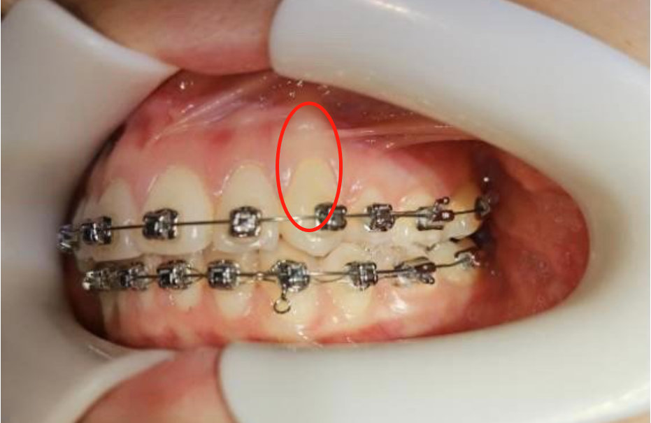 牙齿外伤接近牙龈部有个横的裂纹,牙齿怎么冲破牙槽骨长出来的