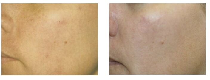 光子嫩肤基础护肤,基础护肤的光子嫩肤