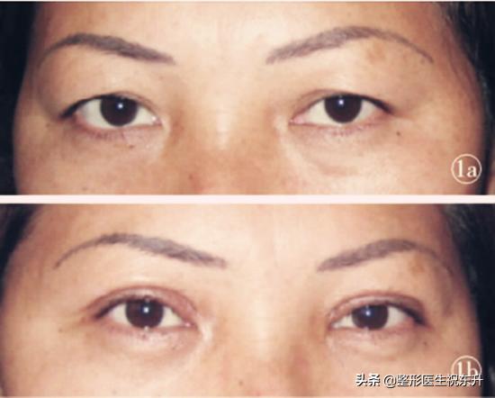 上睑皮肤松弛矫正案例,上睑皮肤松弛下垂解决方法