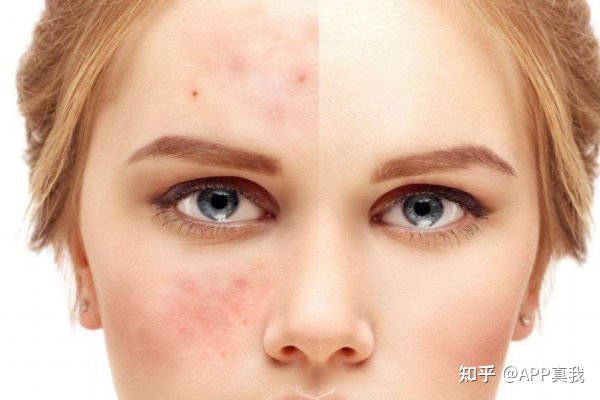 怎么用芦荟胶才能祛痘印,日常生活祛痘印最好的方法是什么