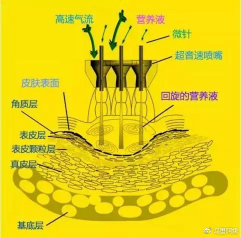 水光针无针孔还是有针孔的好,水光针有针管注射吗
