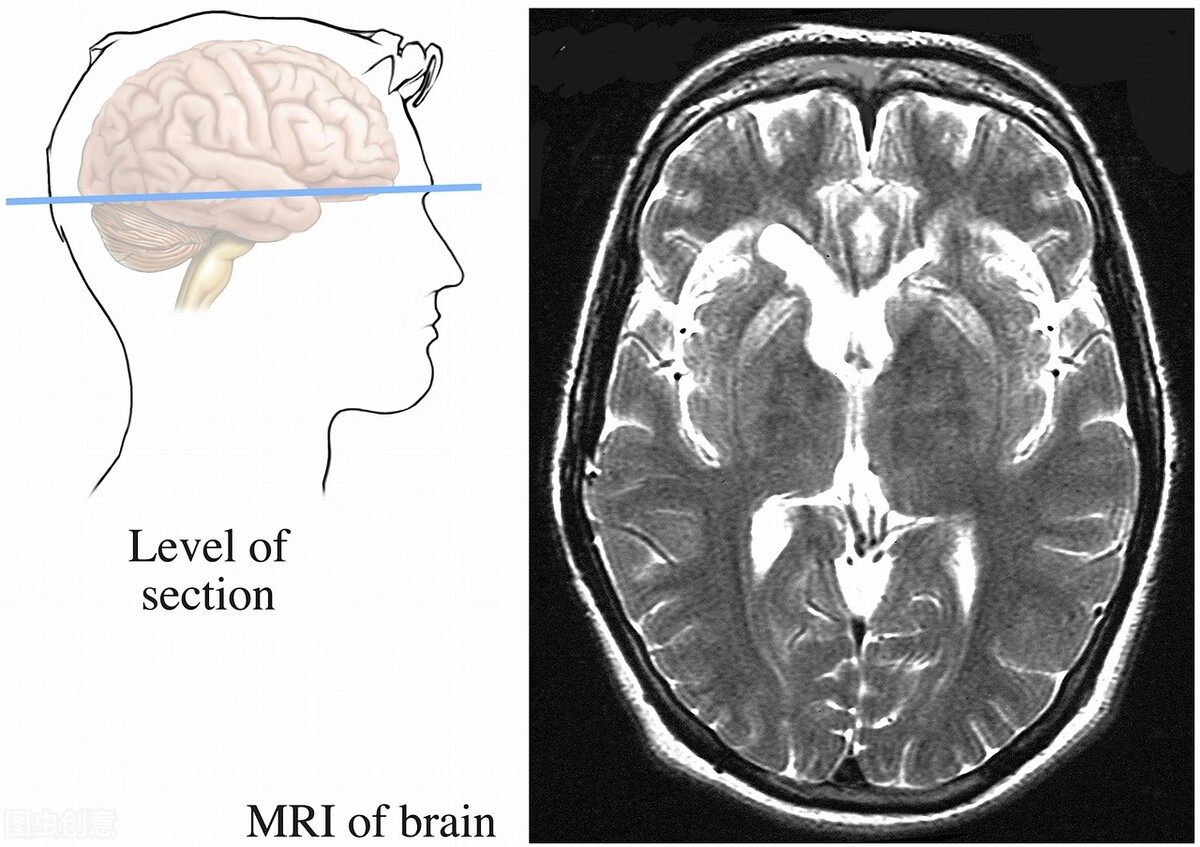 脑梗偏瘫失语有没有自愈的,脑梗偏瘫智能障碍失语怎么治疗
