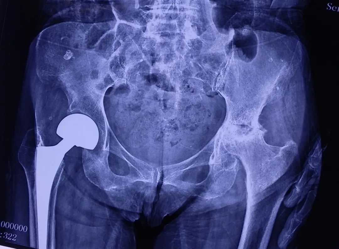 国内全髋关节置换最好的医生,微创全髋关节置换手术与传统置换