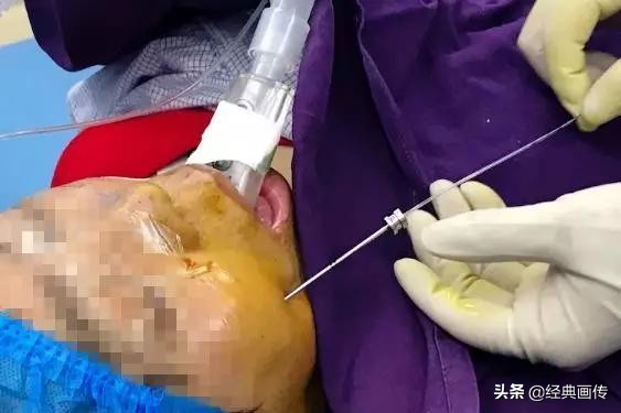 小球囊的功效与作用,小球囊血管扩张术一般多久