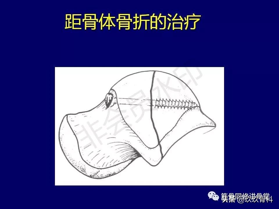 距骨骨折的治疗原则,距骨骨折如何调理