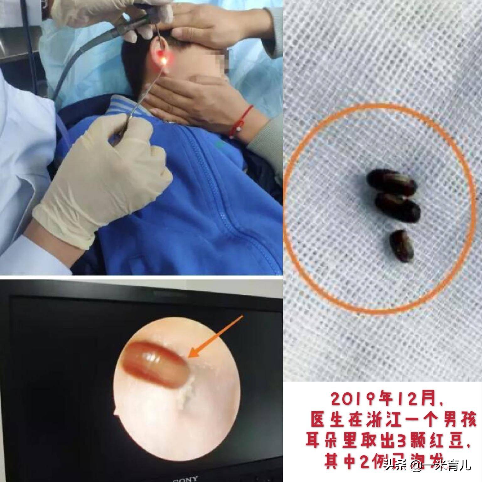 小孩的耳朵怎么护理,宝宝耳朵有异物医生怎么洗