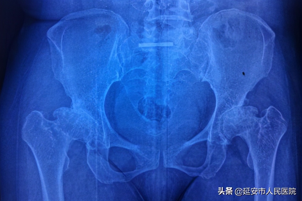 髋关节置换择期手术,南溪区第一例髋关节置换手术
