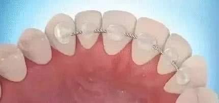 牙齿矫正反弹最快的补救法,牙齿矫正轻微反弹应该怎么办