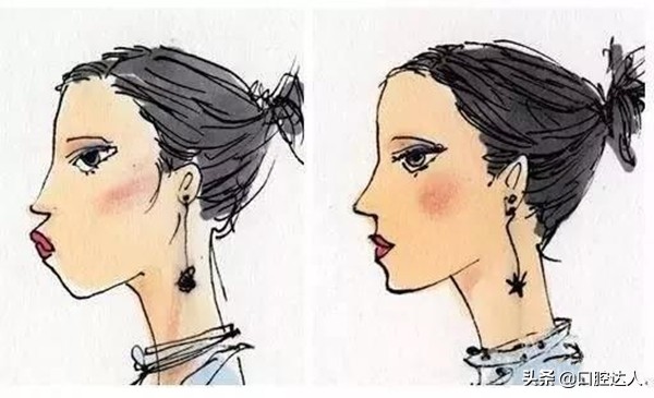 40多岁下排牙齿不齐有必要矫正吗,下排牙齿不齐切片局部矫正