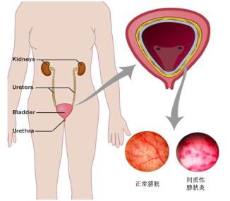 女士尿痛可能会是怎么回事？不一定都是感染