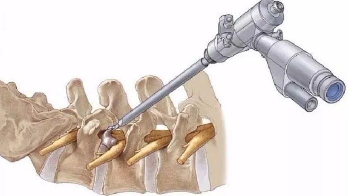 医生,我有颈椎病但不想手术!嗯,你每天跑步就能好,你信不信?